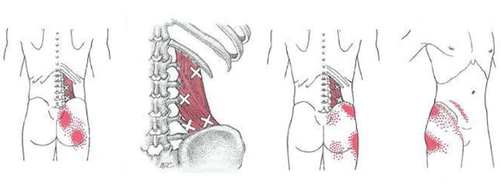 脊柱管狭窄症に関連するトリガーポイント
